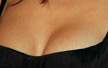 Даже красивую грудь растяжки могут сделать менее привлекательной стрии