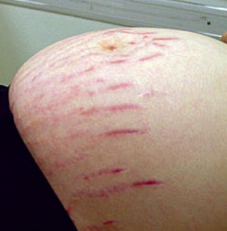 на последних месяцах беременности растяжки во время беременности