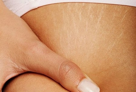 причина растяжек