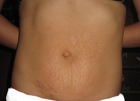 Стрии могут иметь форму полос, зигзагов или волн стрии