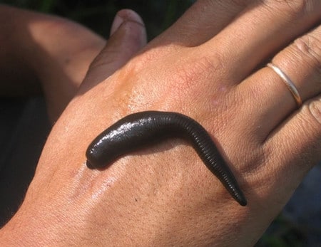 гирудотерапия