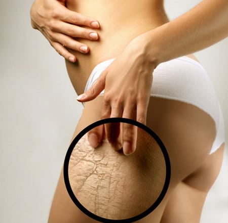 образование стрий почему появляются растяжки