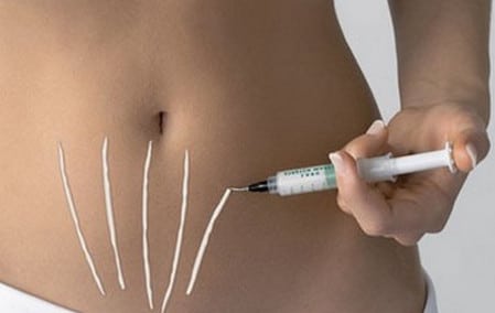 Новые растяжки мумие удаляет практически бесследно как удалить