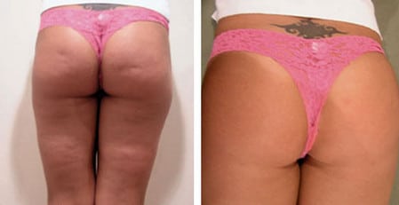 Аппетитные ягодицы иньекции