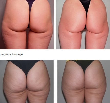 Эффект нескольких процедур процедуры