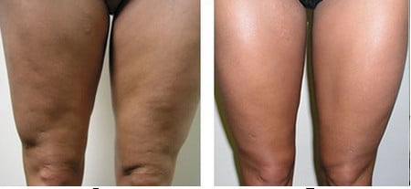 ДО и ПОСЛЕ цикла процедур мезотерапии женские ноги