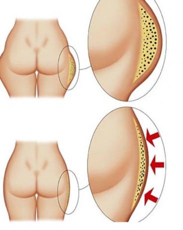 Ненавистные ушки избавление от ущек