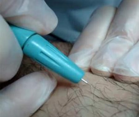 Суть электроэпиляции волосяные луковицы