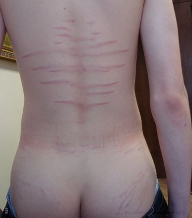 стрии на спине гормональный сбой