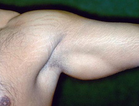 Для профилактики стрий мужчинам необходимо наращивать мышечную массу постепенно профилактика стрий