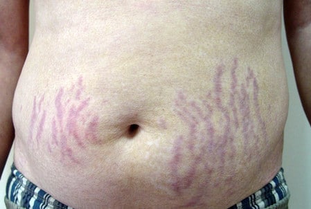 Стрии у мужчин как убрать растяжки