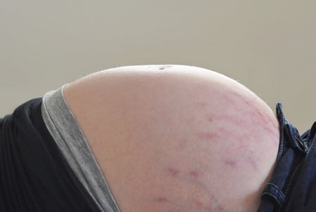 Стрии при беременности профилактика стрий