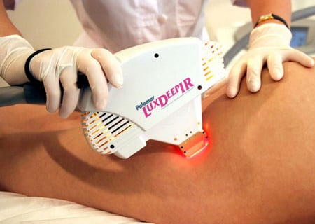 удаление стрий лазером удаление растяжек