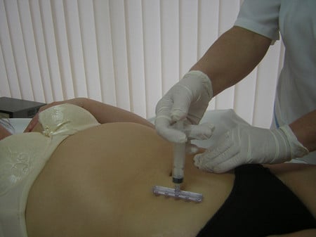 Мезотерапия лечение стрий