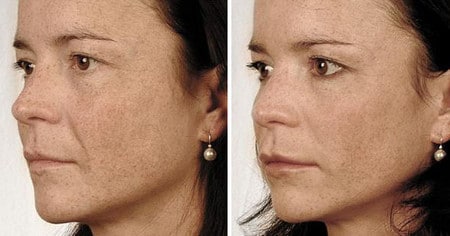 До и после после увеличения