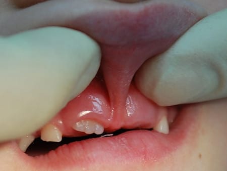 патология уздечки