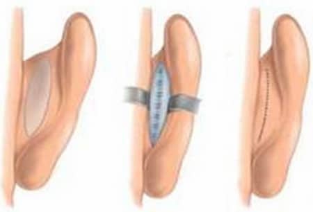 Эстетическая отопластика виды пластики