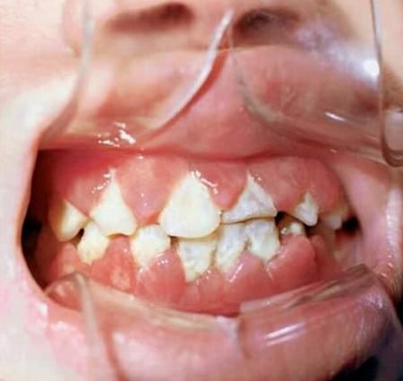 Гингивиты аномалия
