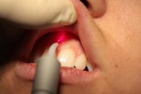 бескровный способ