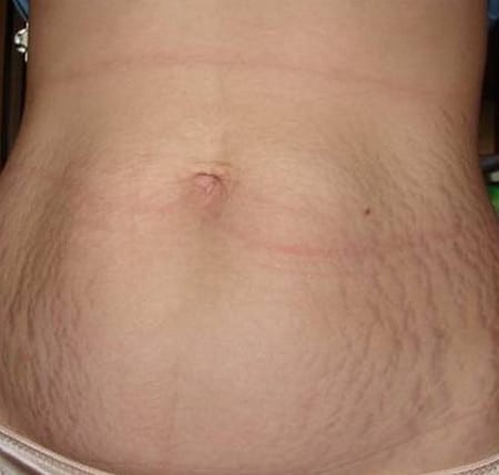 Так выглядят растяжки что делать