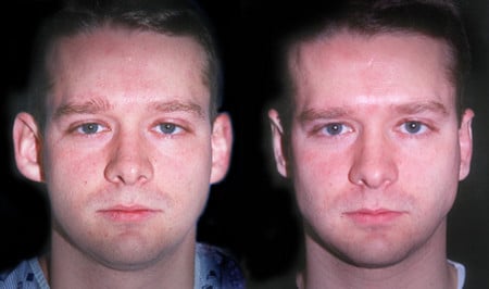 до и после коррекции лопоухости после операции