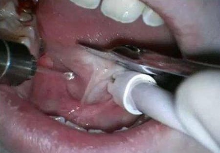 Скальпель хирурга операция