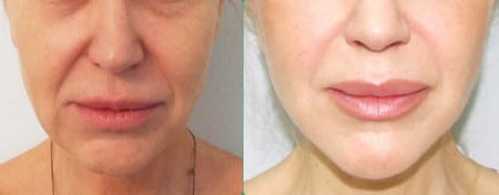 свой материал последствия применения