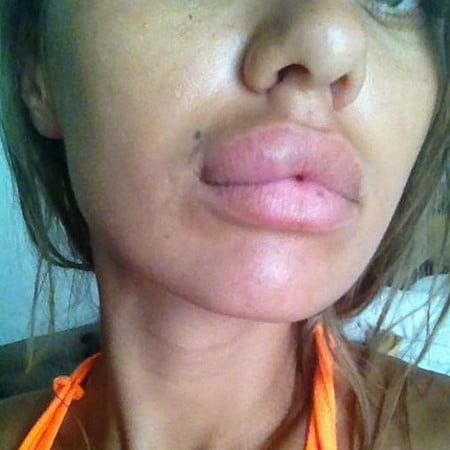 Сложная приживаемость жировых клеток побочный эффект