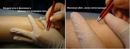 Убитый разрядом тока фолликул фоллткул