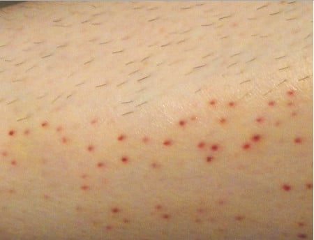 Раздражение после электроэпиляции раздражение