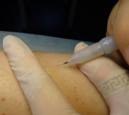 Разрушение фолликула фолликулы