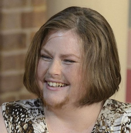 Проявления гирсутизма гирустизма