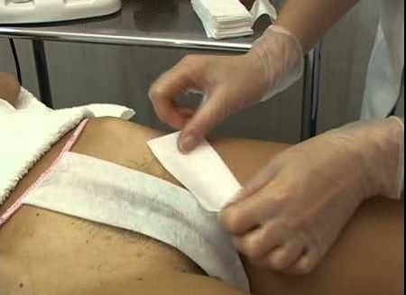 Эпиляция в зоне бекини бекини