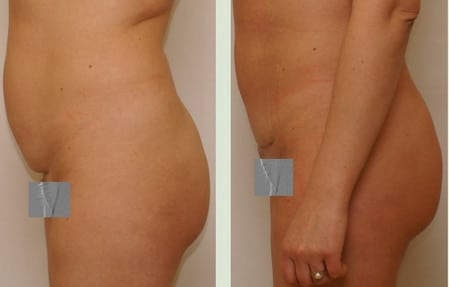 до и после после операции