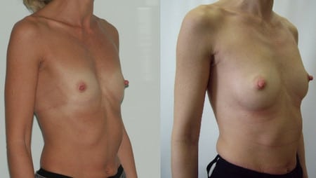Увеличить грудь с помощью собственного жира увеличение груди
