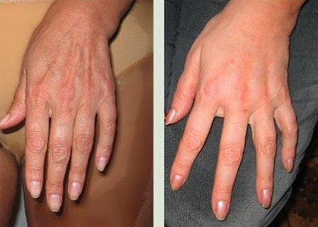 липофилинг на кисти применение липофилинга