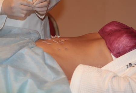 Копролаковая нить нитевой лифтинг