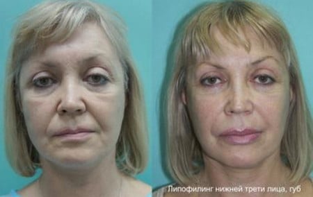 Эффект подтянутой кожи до и после