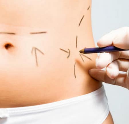 Абдоминопластика проводится под общей анестезией операция