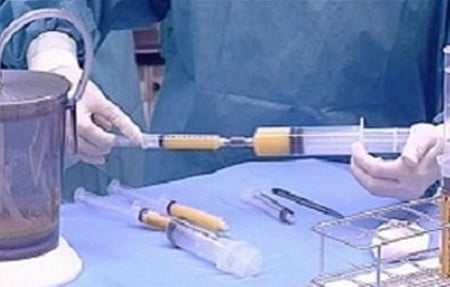 операция липофилинга