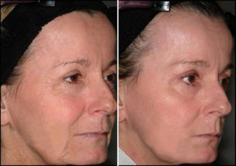 фото до и после