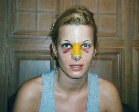 После ринопластики последствия