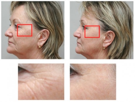 Мезотерапия позволит убрать морщинки вокруг глаз морщинки вокруг глаз