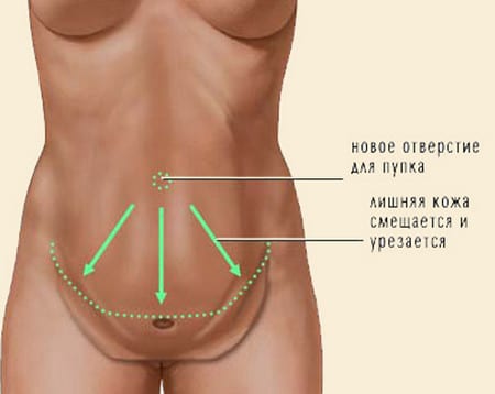 обширная абдоминопластика