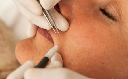 избавиться от ненавистных усиков раз и навсегда Электроэпиляция