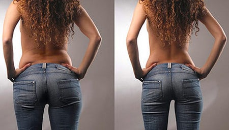 результаты липосакции до и после