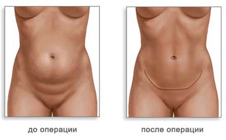 брюшная стенка «украсится» рубцом после операции