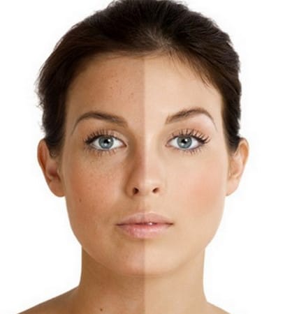 После процедуры выравнивается тон кожи следствие процедуры