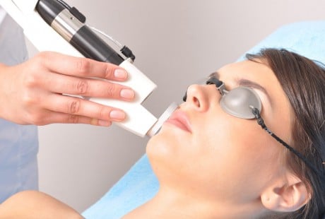 Лазерная эпиляция