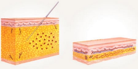 Излишние жировые отложения удаляются при помощи шприцев удаление жира